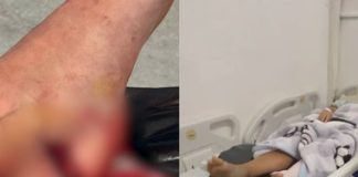 Россиянка травмировалась, упав в колодец отеля на Занзибаре: потеря части пятки шокировала туристов.